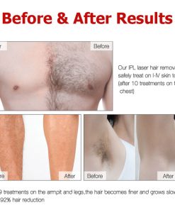 Permanent Laser Hair Removal Machine White - Permanent & Premium Quality 8 Laser hair removal price in Bangladesh