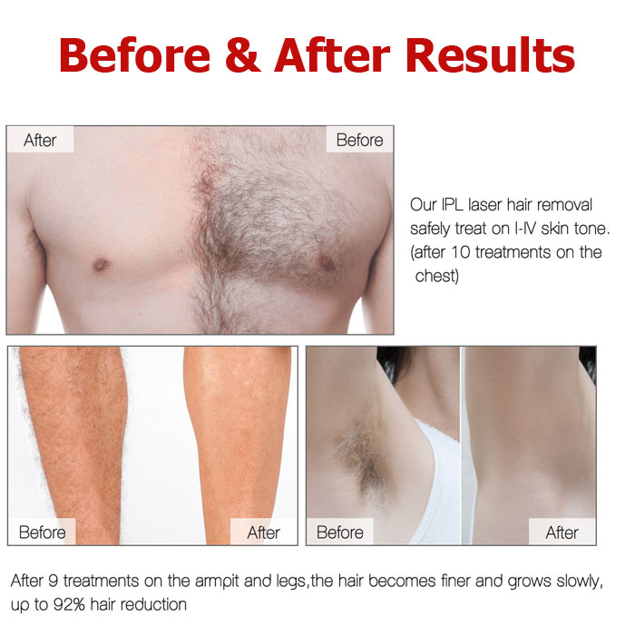 Laser hair removal price in Bangladesh - Permanent & Premium Quality -  Techno Health