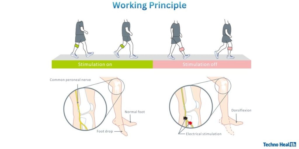XFT-2001F G5 Foot Drop System